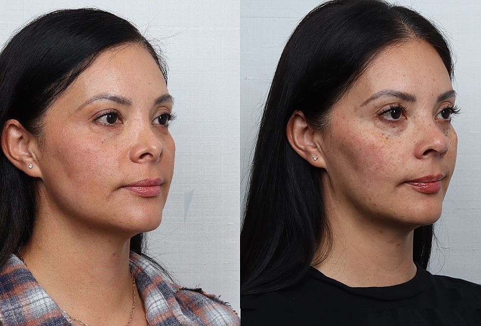 Revision Rhinoplasty Before & After