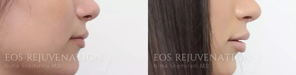 Lip Filler Before & After