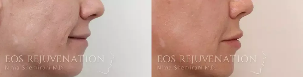 Lip Filler Before & After