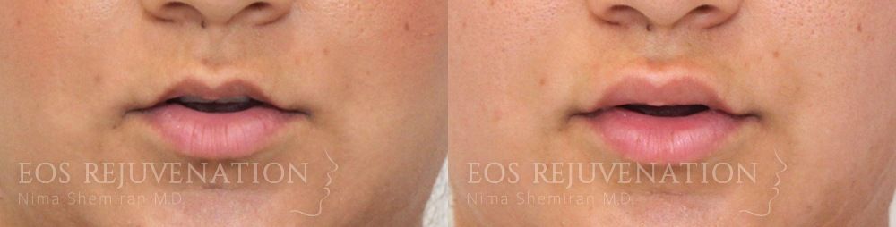 Lip Filler Before & After