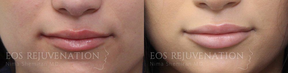 Lip Filler Before & After