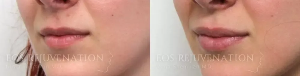 Lip Filler Before & After