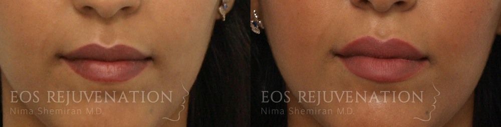 Lip Filler Before & After