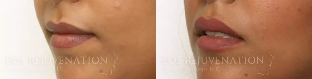 Lip Filler Before & After