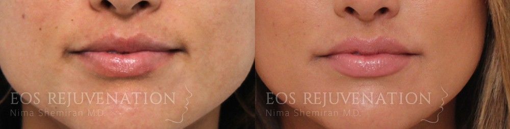 Lip Filler Before & After