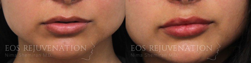 Lip Filler Before & After