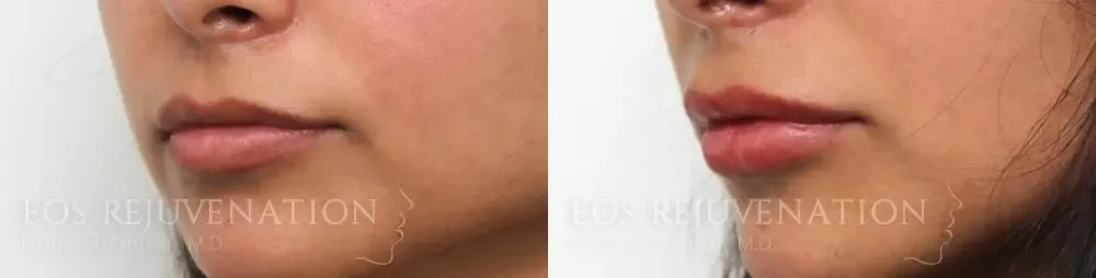 Lip Filler Before & After