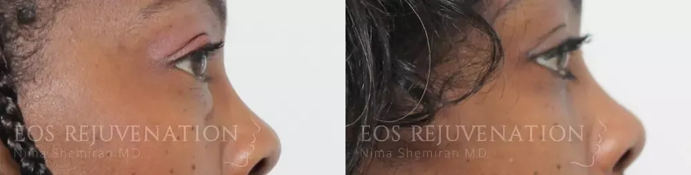 Lower Blepharoplasty Before & After