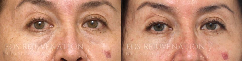 Lower Blepharoplasty Before & After