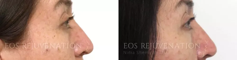 Lower Blepharoplasty Before & After