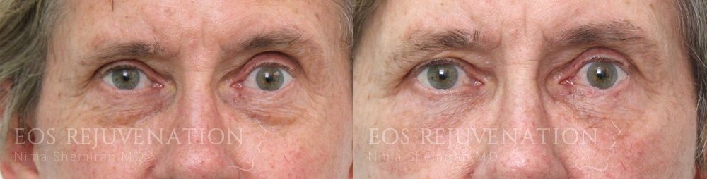 Lower Blepharoplasty Before & After