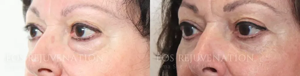 Lower Blepharoplasty Before & After
