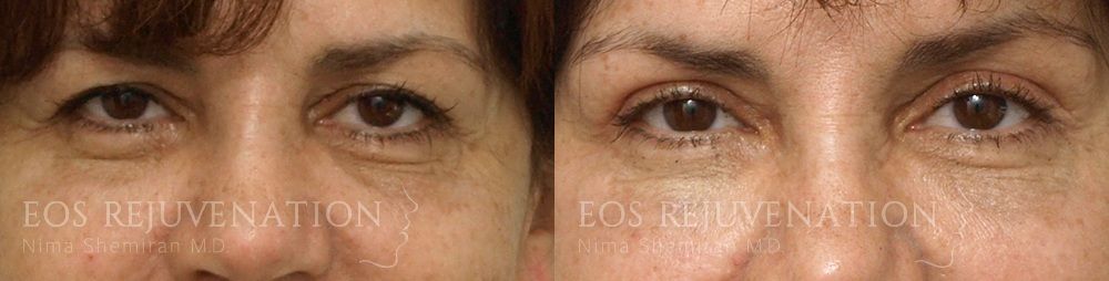 Lower Blepharoplasty Before & After