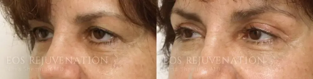 Lower Blepharoplasty Before & After