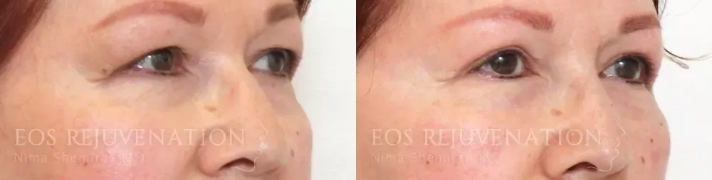 Lower Blepharoplasty Before & After