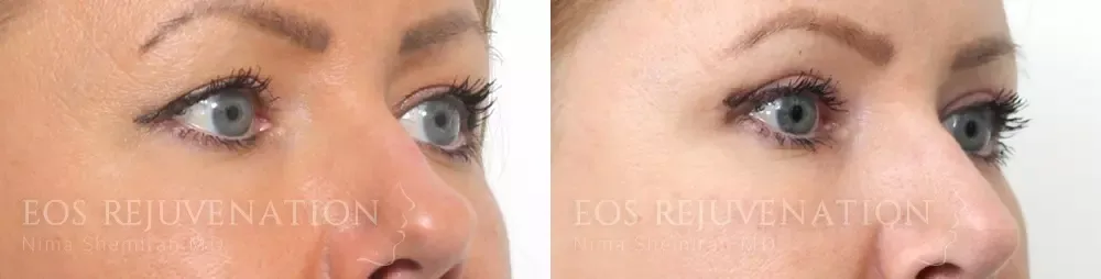 Upper Blepharoplasty Before & After