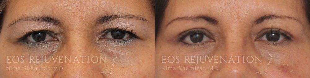 Upper Blepharoplasty Before & After