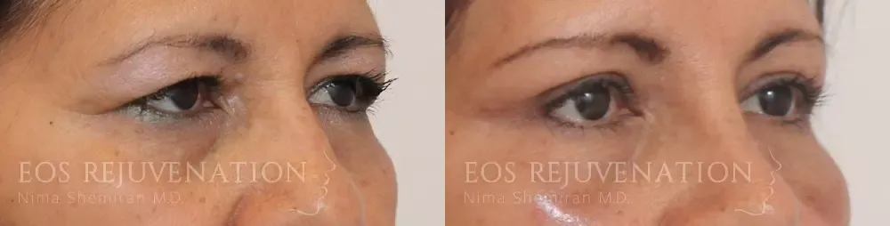 Upper Blepharoplasty Before & After