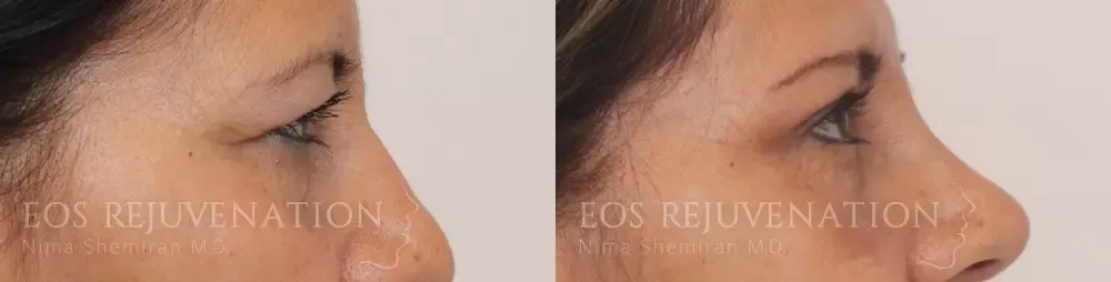 Upper Blepharoplasty Before & After