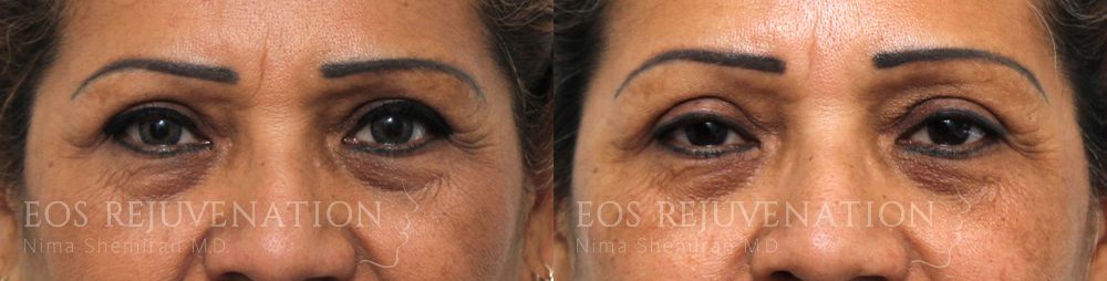 Upper Blepharoplasty Before & After