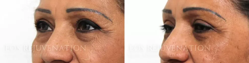 Upper Blepharoplasty Before & After