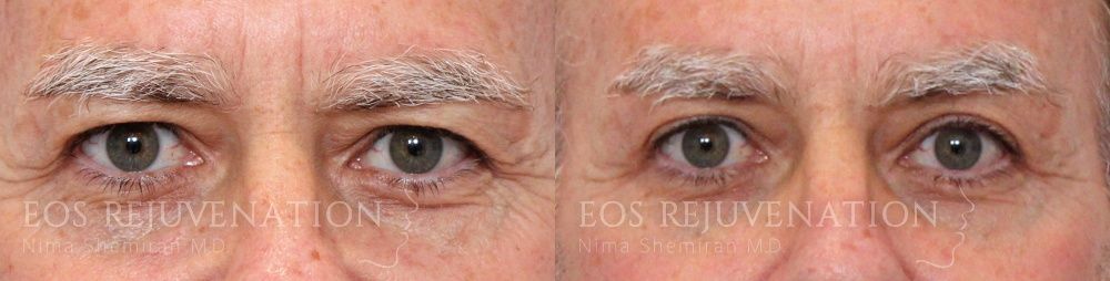 Upper Blepharoplasty Before & After