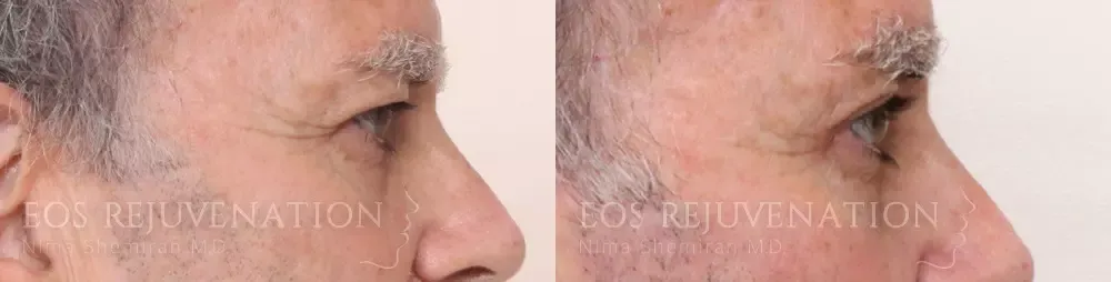 Upper Blepharoplasty Before & After