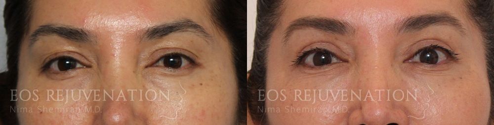 Upper Blepharoplasty Before & After