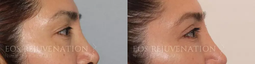 Upper Blepharoplasty Before & After