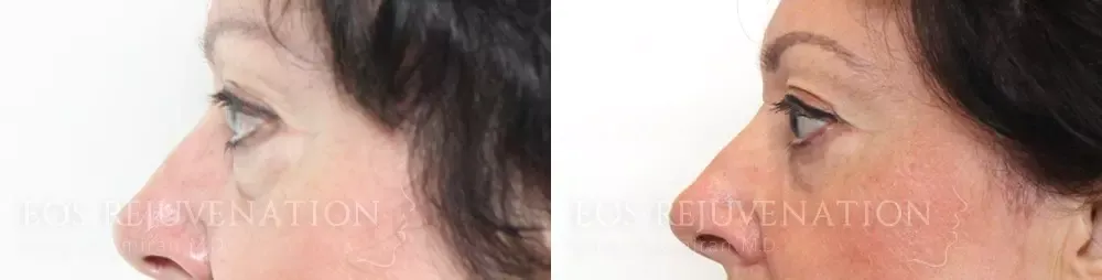 Upper Blepharoplasty Before & After