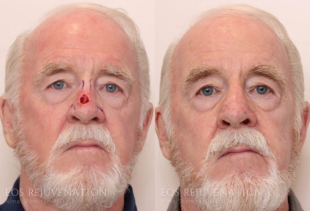 Skin Facial Reconstruction Before & After