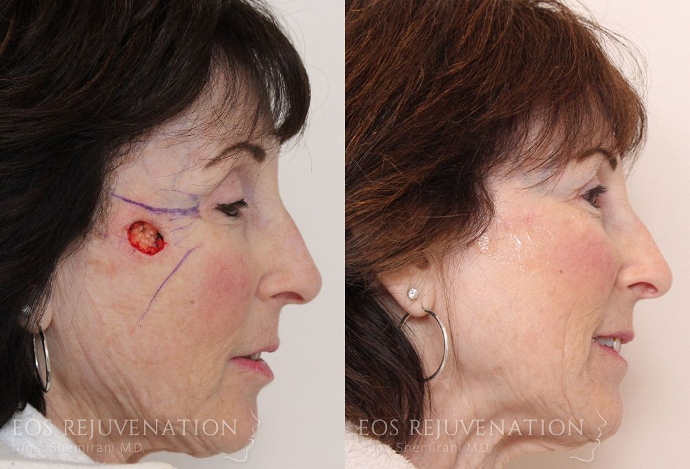 Skin Facial Reconstruction Before & After