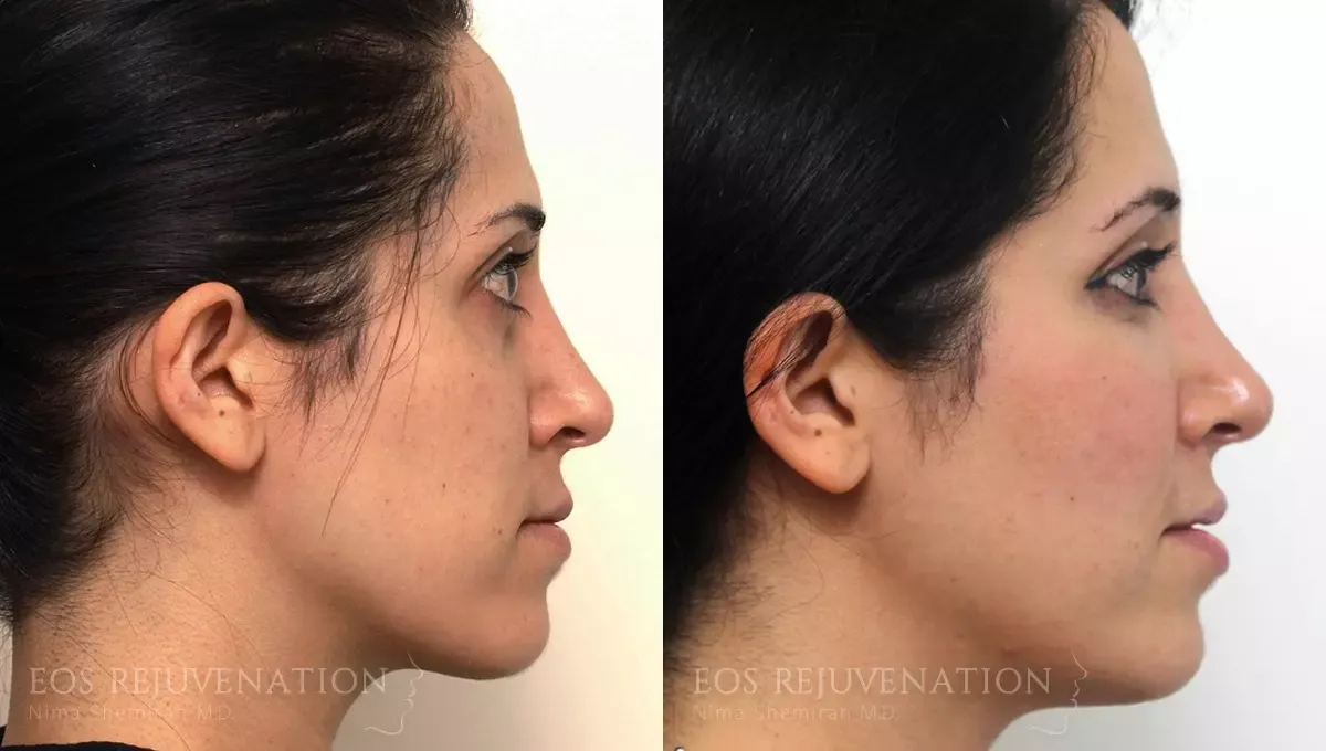 Fat Transfer Before & After