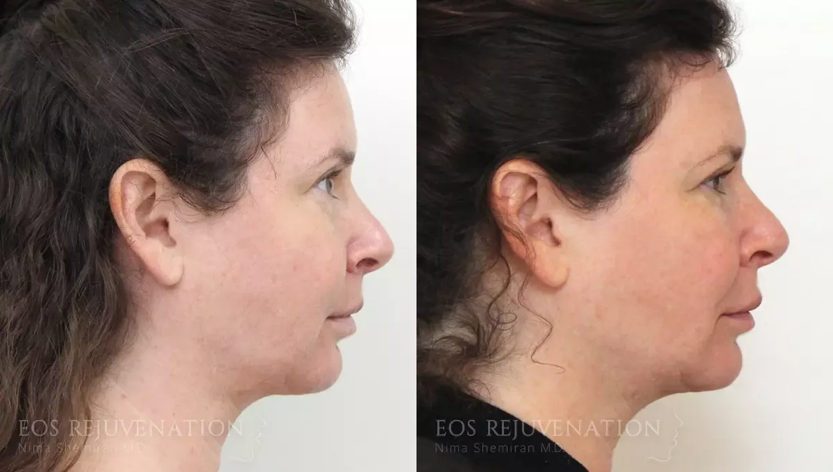 Fat Transfer Before & After