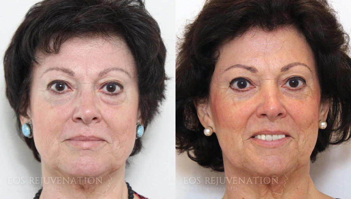 Fat Transfer Before & After