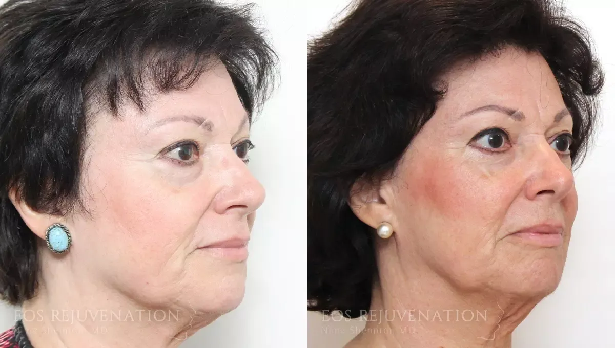 Fat Transfer Before & After