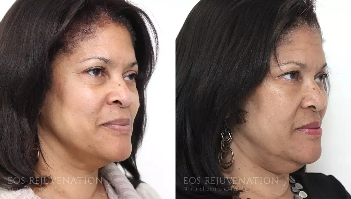 Fat Transfer Before & After