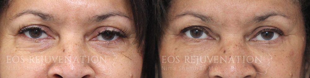 Blepharoplasty Before & After