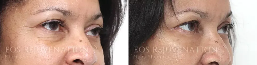 Blepharoplasty Before & After