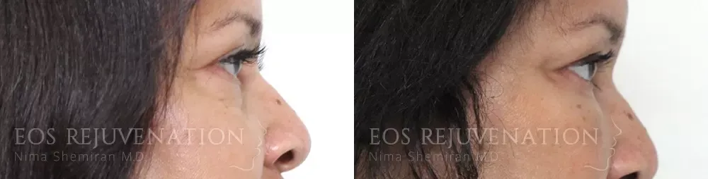 Blepharoplasty Before & After