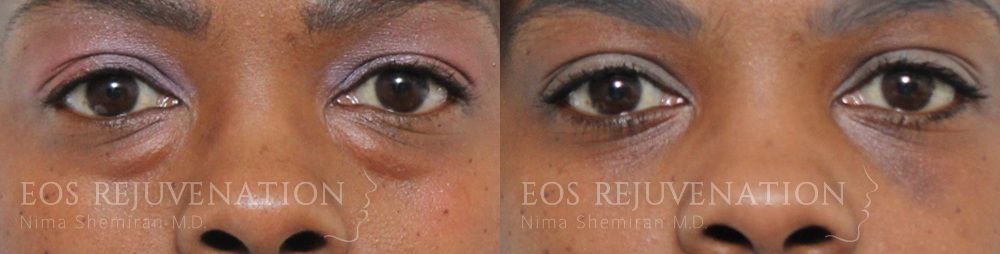 Blepharoplasty Before & After