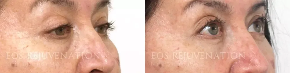 Blepharoplasty Before & After