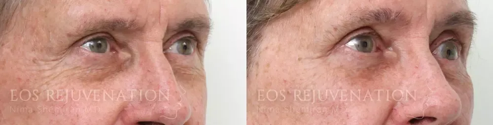 Blepharoplasty Before & After