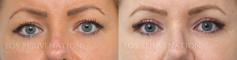 Blepharoplasty Before & After