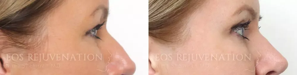 Blepharoplasty Before & After