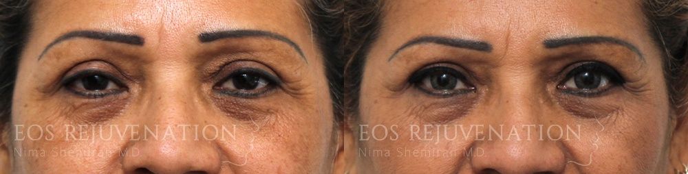 Blepharoplasty Before & After