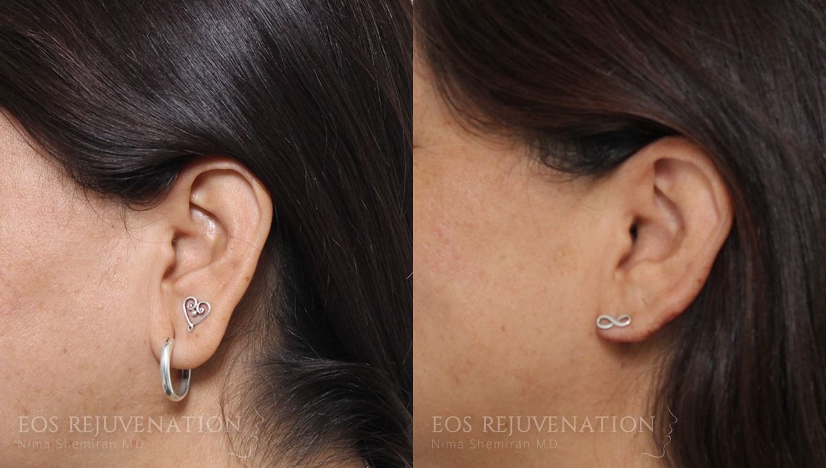 Earlobe Reduction Before & After