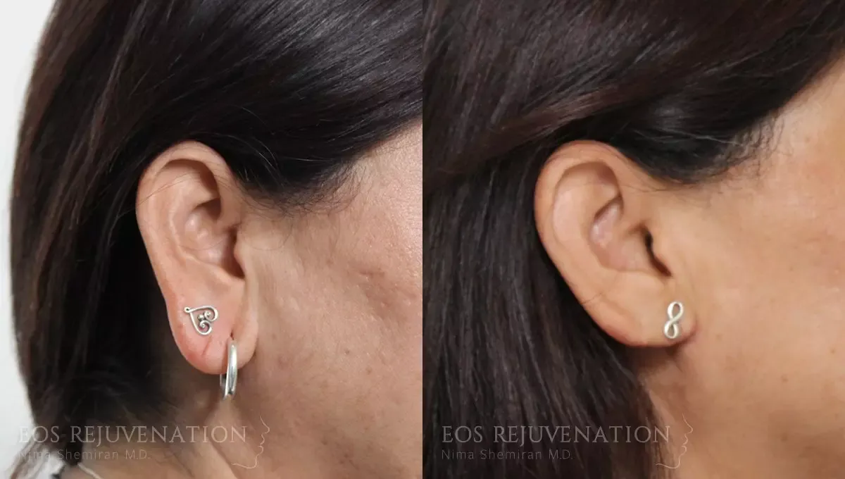Earlobe Reduction Before & After
