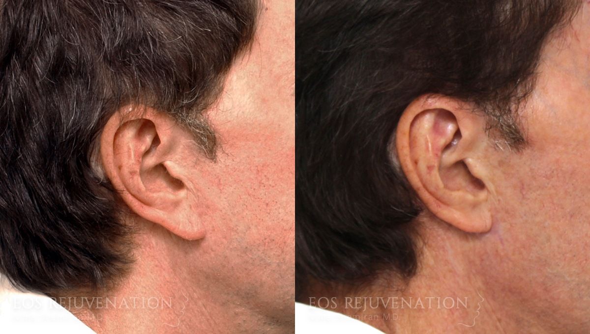 Earlobe Reduction Before & After