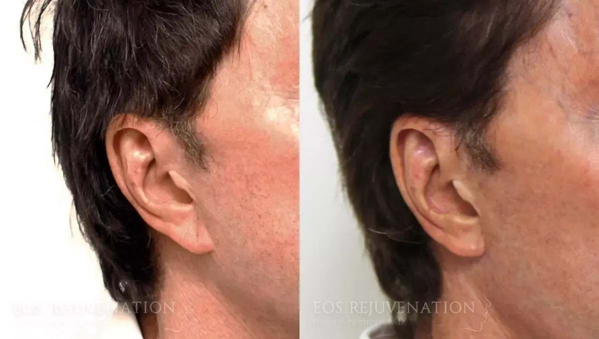 Earlobe Reduction Before & After